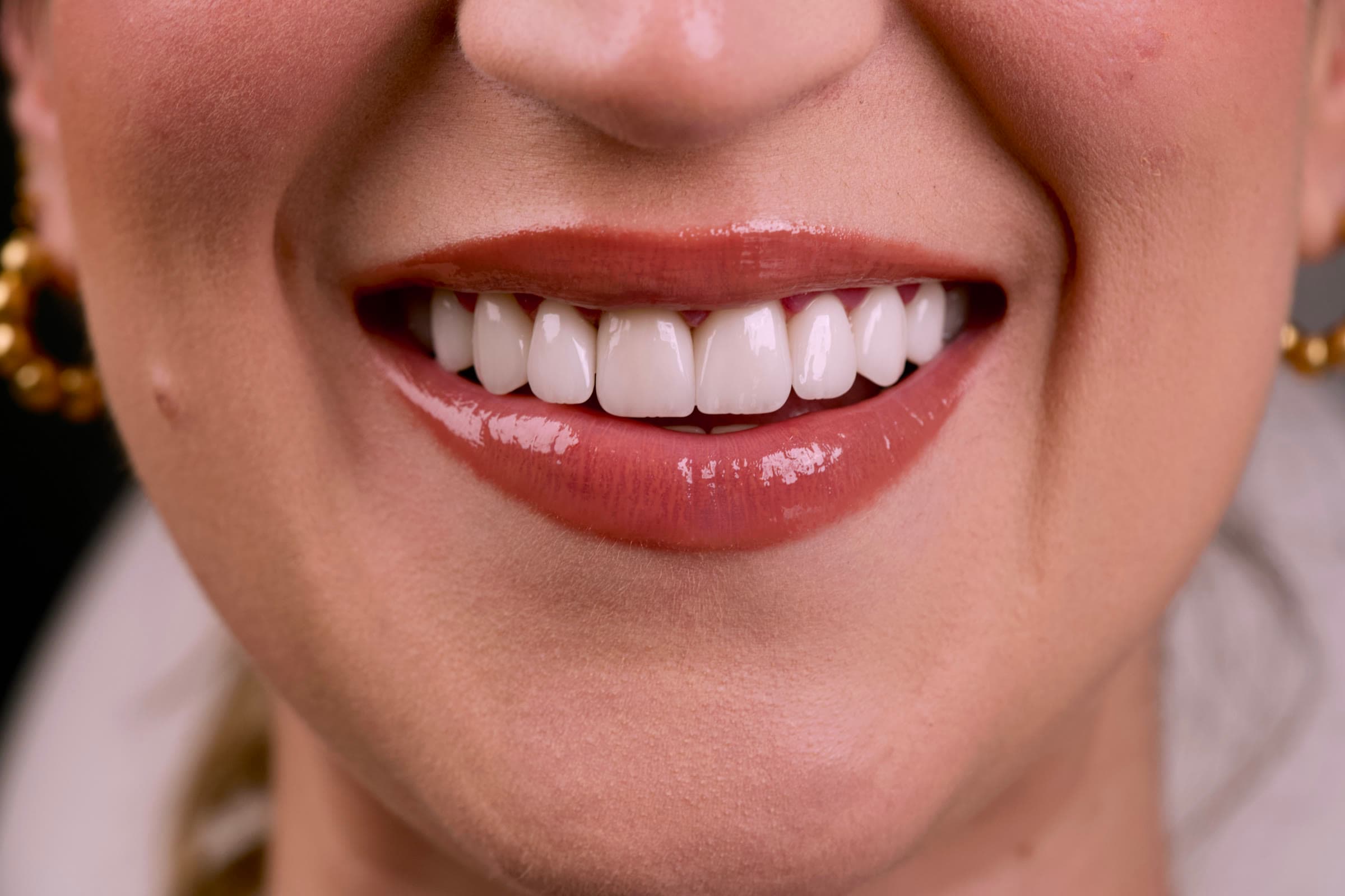 Smile result