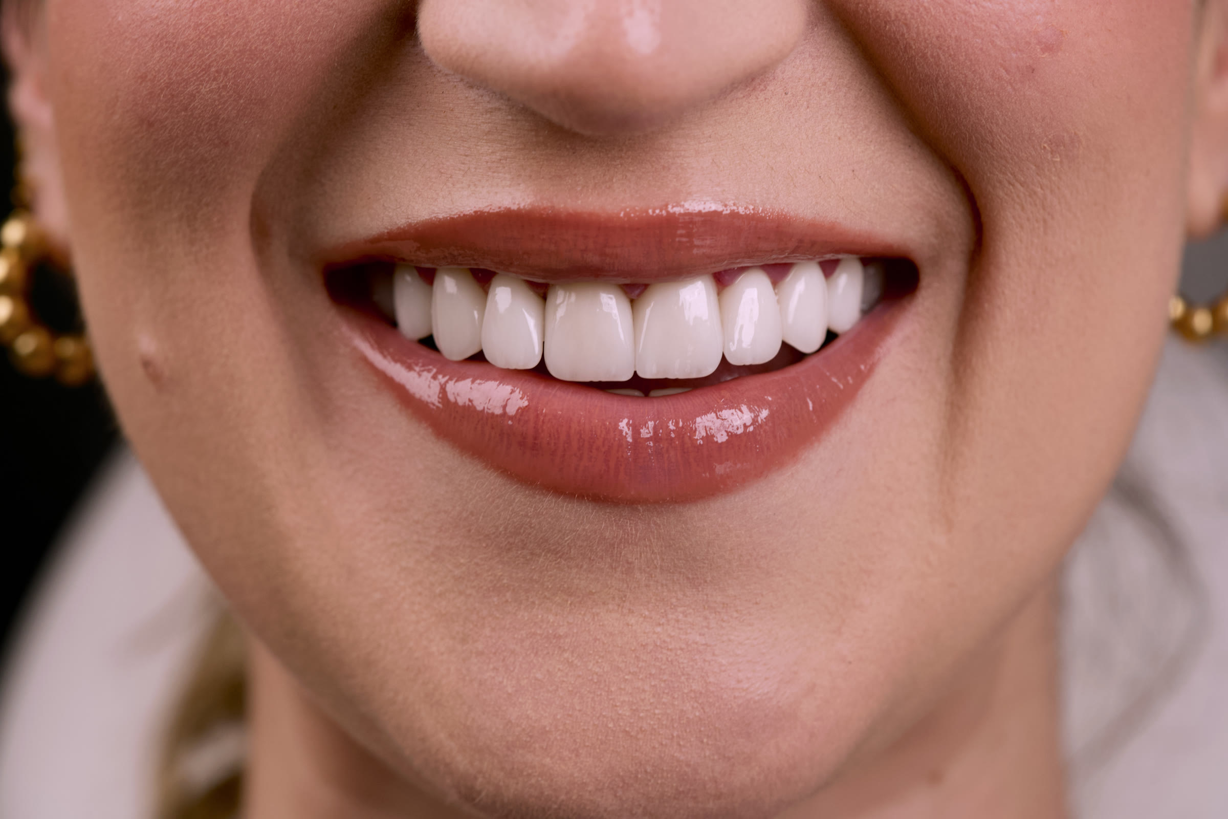 Smile result