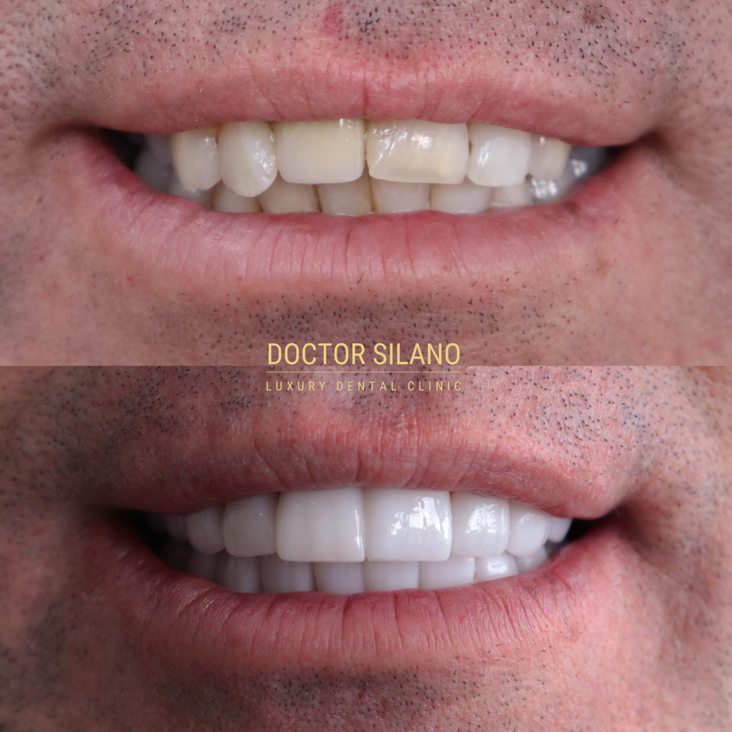 Smile Design Medellín Porcelain Veneers Medellin Teeth Whitening