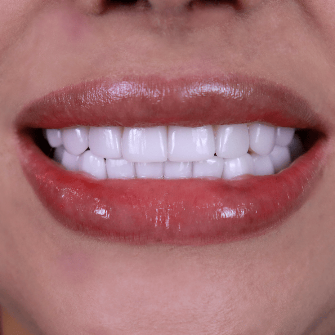 After porcelain veneers treatment showing perfectly aligned, bright white, and natural-looking teeth – smile makeover by Doctor Silano in Medellín