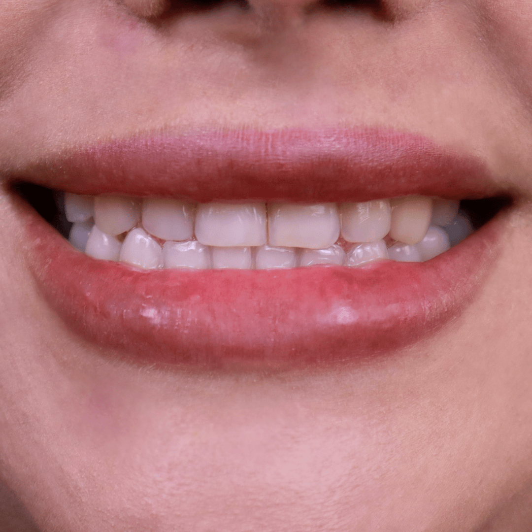 Before porcelain veneers treatment showing mild misalignment, uneven edges, and tooth discoloration – cosmetic dentistry case by Doctor Silano in Medellín