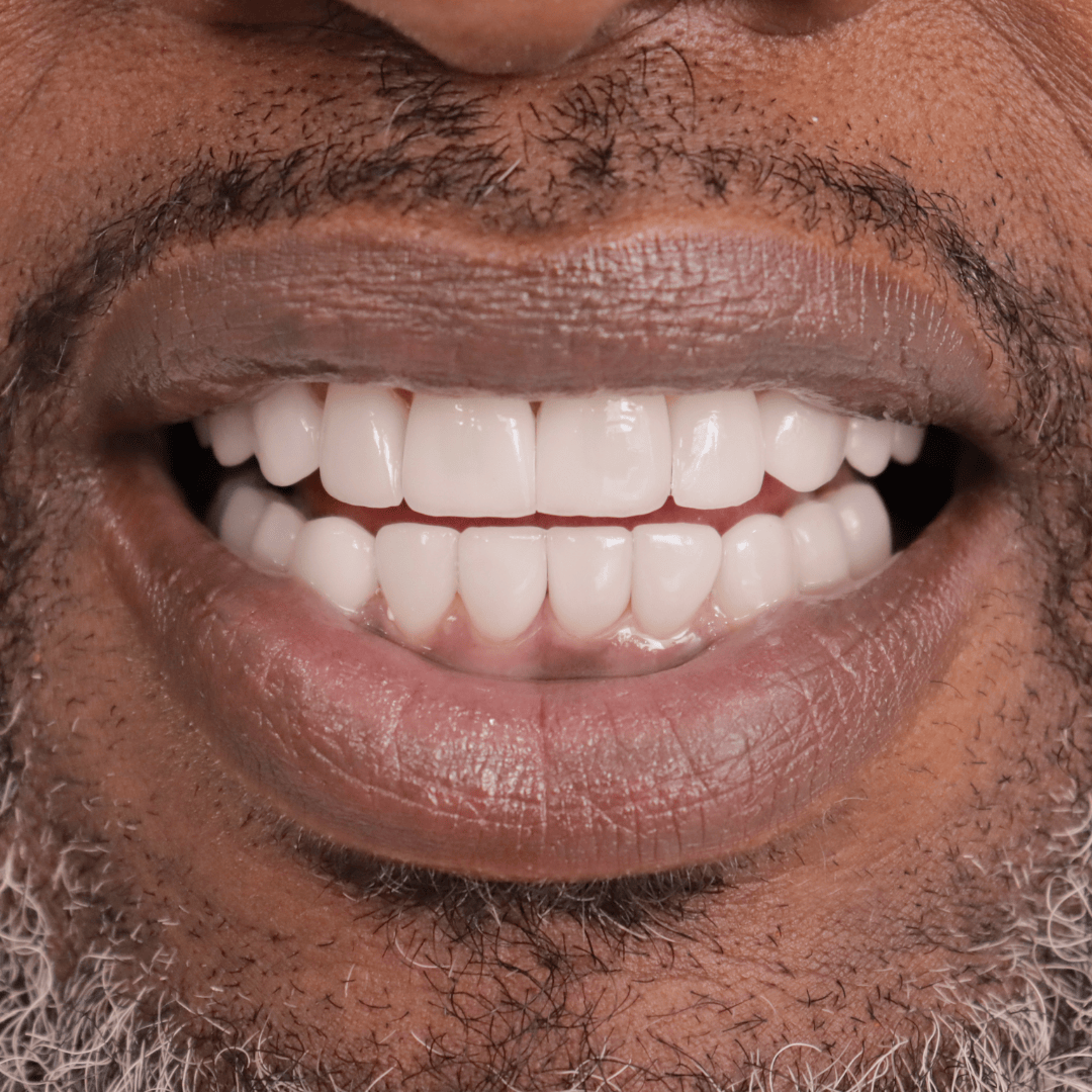 Before porcelain veneers showing misaligned, spaced, and discolored teeth – cosmetic dentistry case by Doctor Silano in Medellín