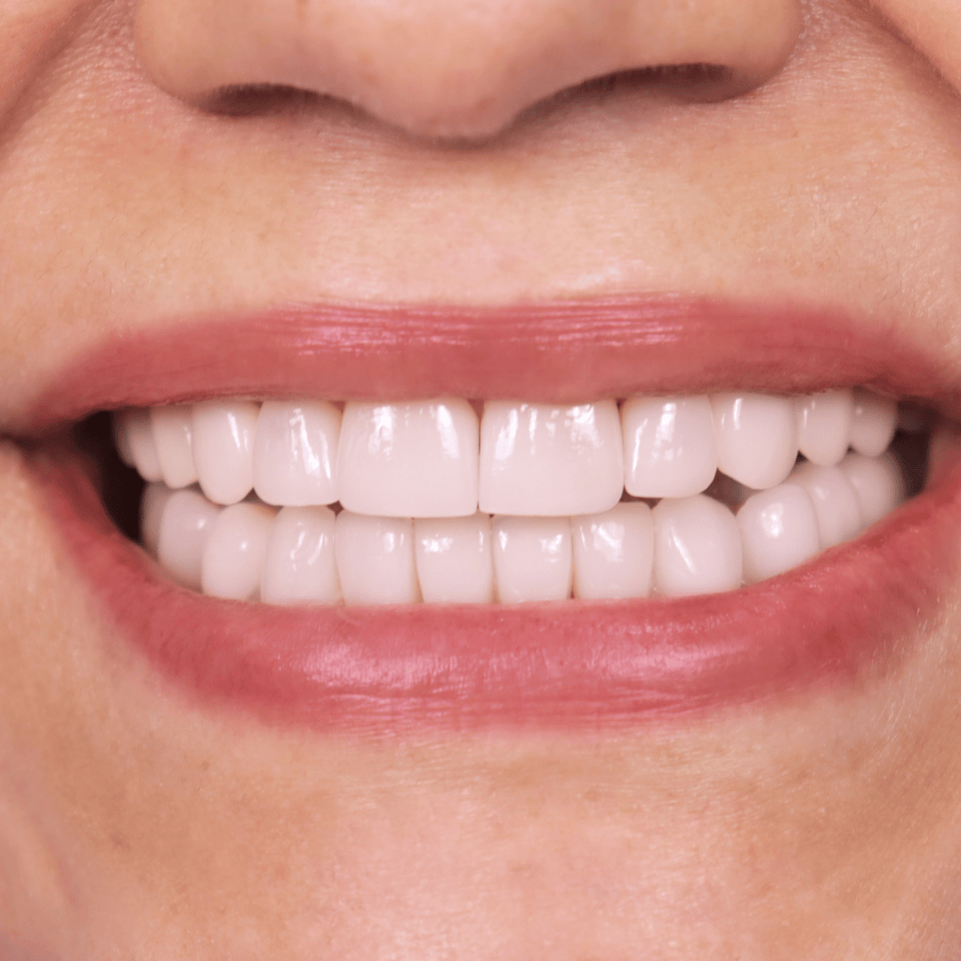 After porcelain veneers treatment with perfectly aligned, white, and natural smile – cosmetic dentistry by Doctor Silano in Medellín