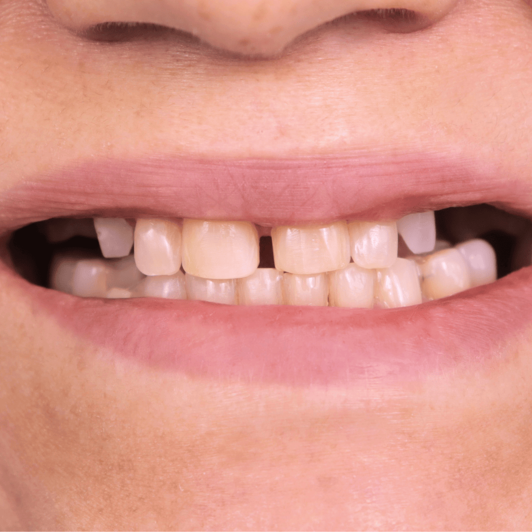 Before porcelain veneers treatment showing teeth gaps, discoloration, and uneven alignment – cosmetic dentistry case by Doctor Silano in Medellín
